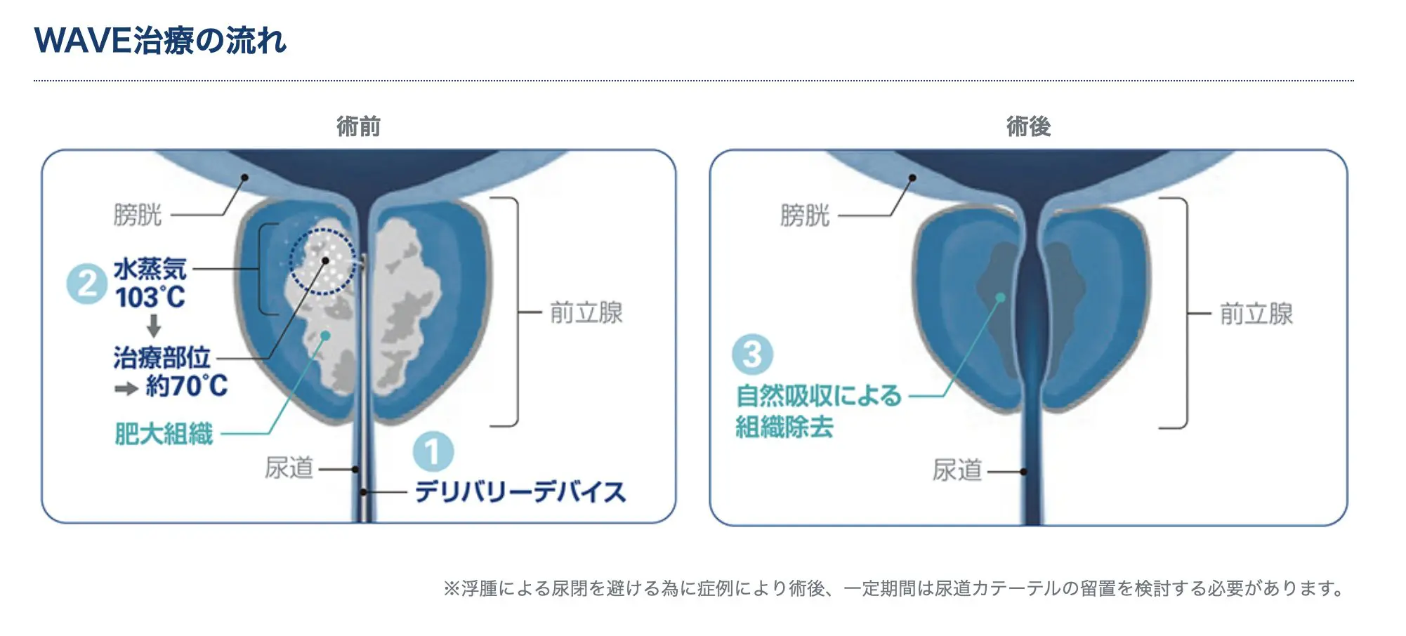 Rezumレジューム 前立腺水蒸気治療システム ”奈良市” OR ”奈良の前立腺肥大” OR ”奈良市の前立腺肥大” OR ”京都の前立腺肥大” OR  ”大阪の前立腺肥大” OR”大和郡山市” OR ”近鉄沿線” OR ”生駒の前立腺肥大” OR”日帰り手術” OR”大阪 日帰り手術” OR ”京都  日帰り手術” OR ...